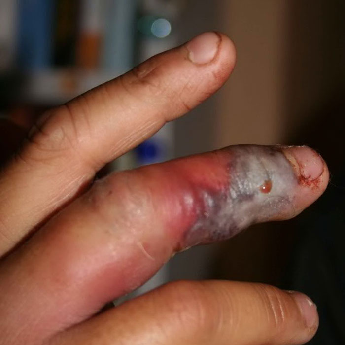 Мозамбикская кобра укусила человека в руку