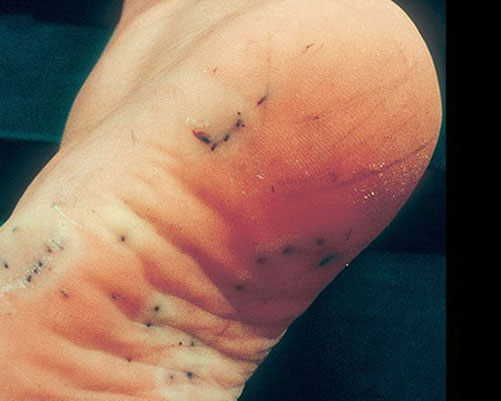 Фотография стопы человека со следами от иголок морского ежа