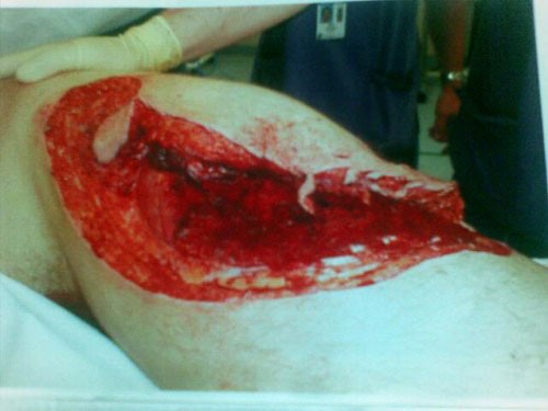 Нога человека после нападения акулы
